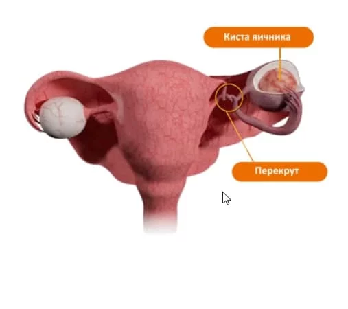 Перекрут трубы у женщины причины