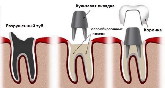 Отторжение зубов после имплантации, симптомы и причины