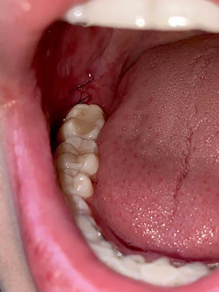 Альвеолит Лунки После Удаления Зуба