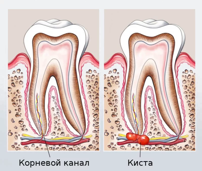 Киста зуба: причины, симптомы, правильное лечение — вороковский.рф