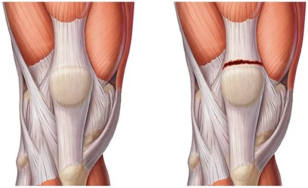 Лечение растяжения связок под коленом сзади | Клиника Temed