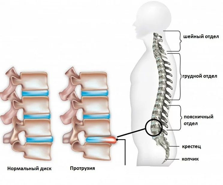 Упражнения для спины при грыже позвоночника. Клиника Март в Санкт-Петербурге