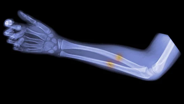 Как ускорить срастание костей после перелома при помощи УВТ