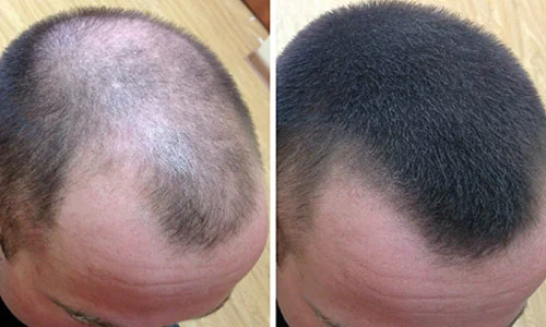 Восстановление волос после ковида