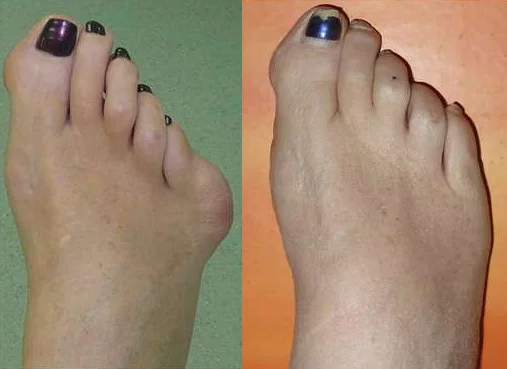 💙 󾬓 Халлюкс ригидус 💙 󾬓 Лечение артроза большого пальца ноги в Запорожье