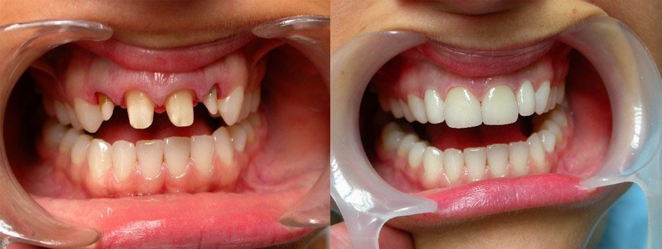 Как происходит удлинение (наращивание) зубов