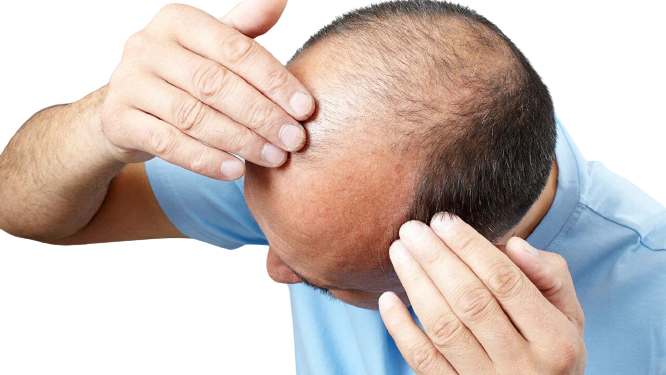 ЕЩЕ 3 причины, по которым пациенты откладывают пересадку волос