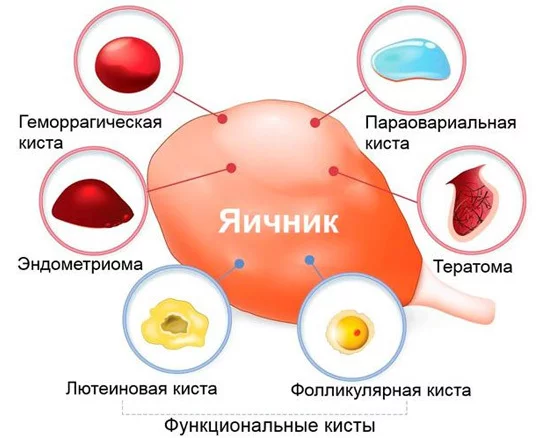 Тератома яичника: разновидности, симптомы и лечение