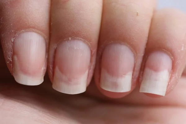 Онихолизис (отслоение ногтя) – причины, симптомы, лечение