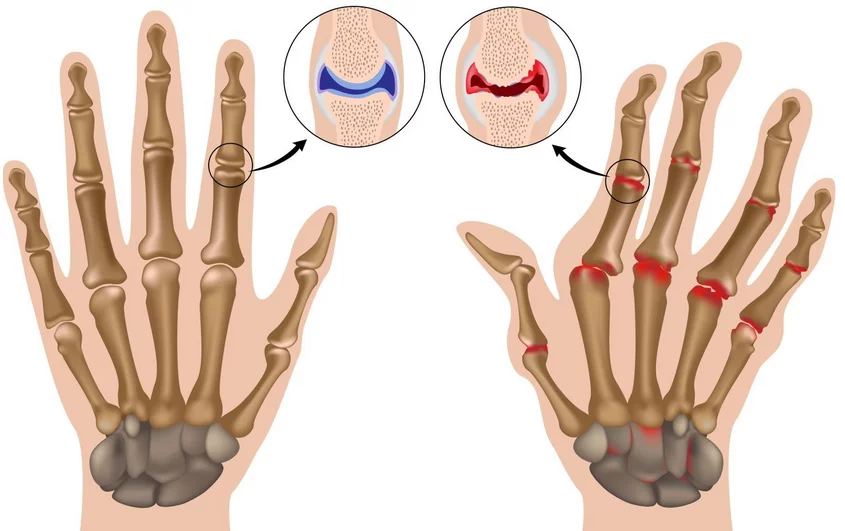 Почему немеет палец средний на левой руке: основные причины и возможные лечебные методы