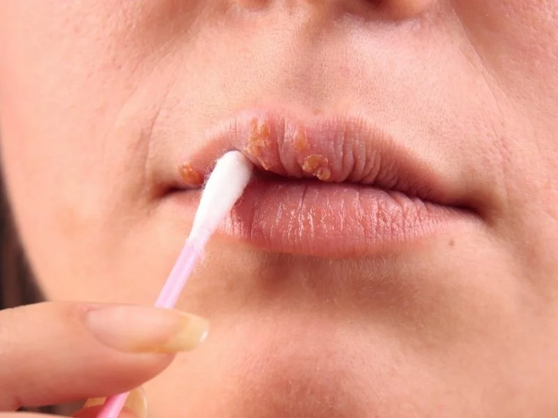Лечение герпеса на губах с помощью лазера в клинике «Диал-Дент»