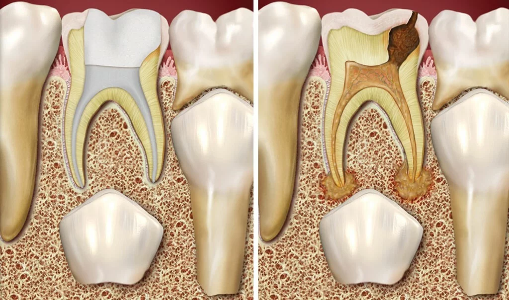 Болит зуб под пломбой: что делать?