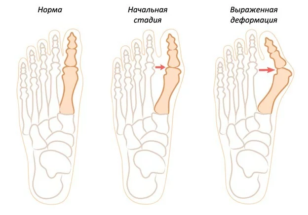 Почему отекают ноги и руки - причины и лечение с участием лимфатической системы