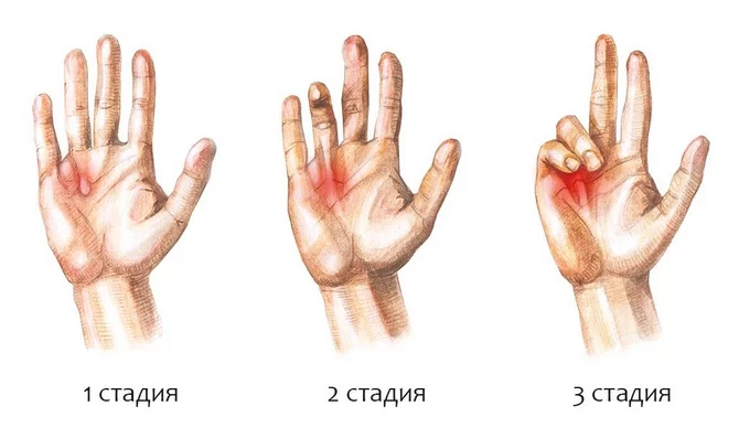 Почему болят суставы пальцев рук?